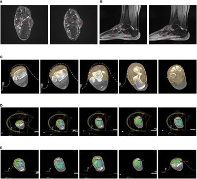 Exploration of the molecular biological mechanisms and review of postoperative radiotherapy cases in tenosynovial giant cell tumors